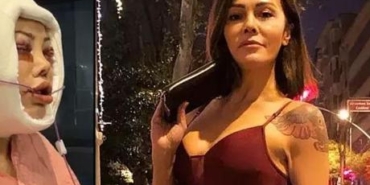 Yuz-nakli-operasyonuyla-Didem-Ceranin-sasirtici-donusumu-featured
