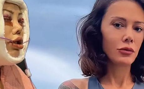 Didem-Ceran-yuz-nakli-sonrasi-yasadigi-sureci-paylasti-featured