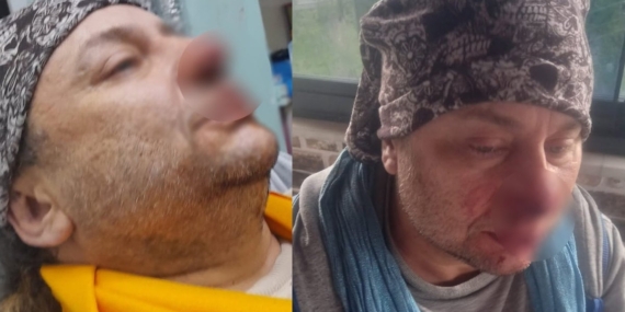 Pitbull-Saldirisina-Ugrayan-Onur-Akayin-Burnundan-Parca-Koptu-featured