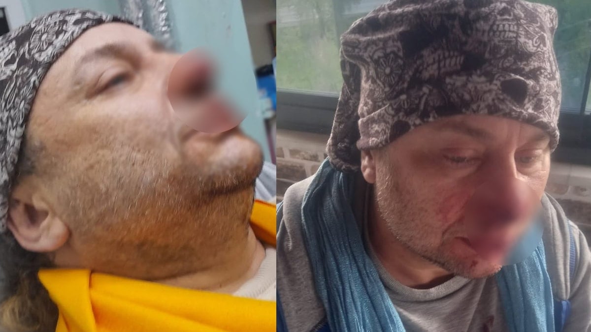 Pitbull-Saldirisina-Ugrayan-Onur-Akayin-Burnundan-Parca-Koptu-featured