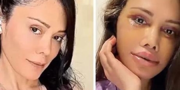 Didem-Ceran-Kore8217deki-estetik-operasyonunun-ardindan-son-halini-paylasti-featured